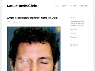 Go to on Symptoms and Natural Treatment Method of vitiligo www.Webcred.it
